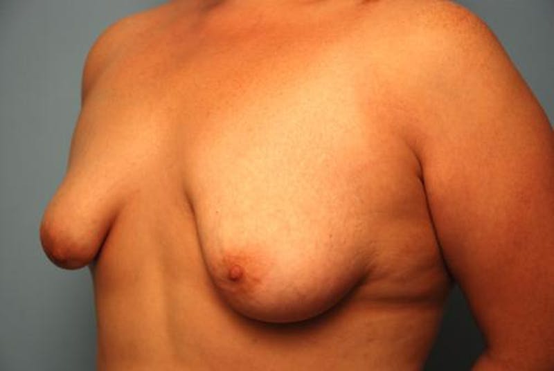 Breast Asymmetry Correction Before & After Gallery - Patient 287679 - Image 3