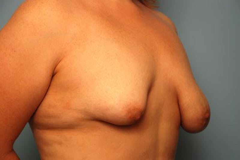 Breast Asymmetry Correction Before & After Gallery - Patient 287679 - Image 5