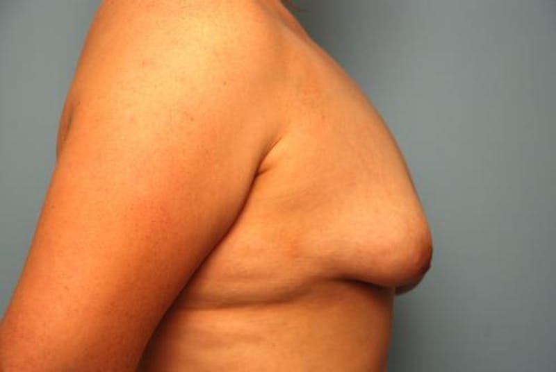 Breast Asymmetry Correction Before & After Gallery - Patient 287679 - Image 7