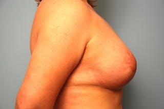 Breast Asymmetry Correction Before & After Gallery - Patient 287679 - Image 8