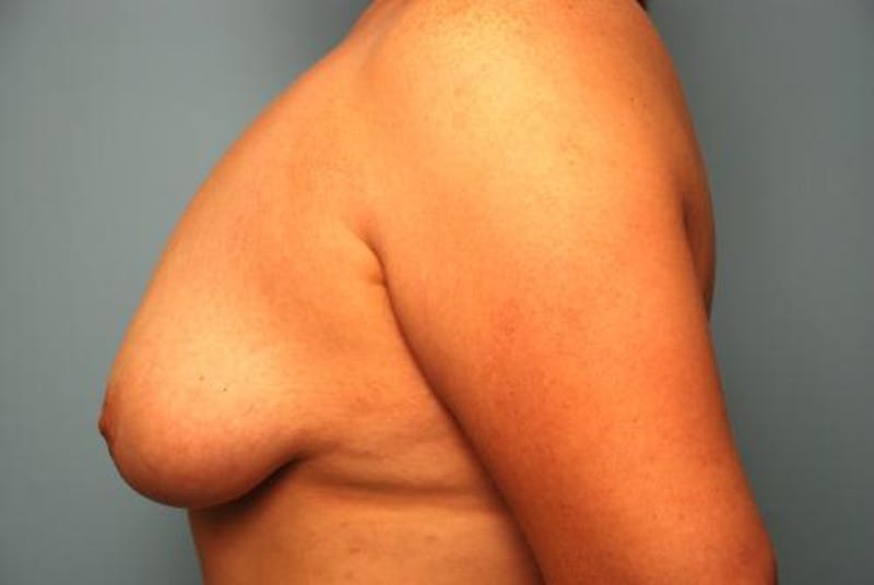 Breast Asymmetry Correction Before & After Gallery - Patient 287679 - Image 9