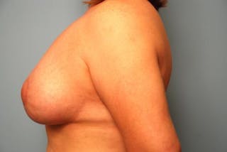Breast Asymmetry Correction Before & After Gallery - Patient 287679 - Image 10