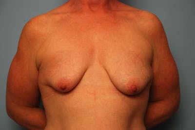 Breast Asymmetry Correction Before & After Gallery - Patient 355499 - Image 1