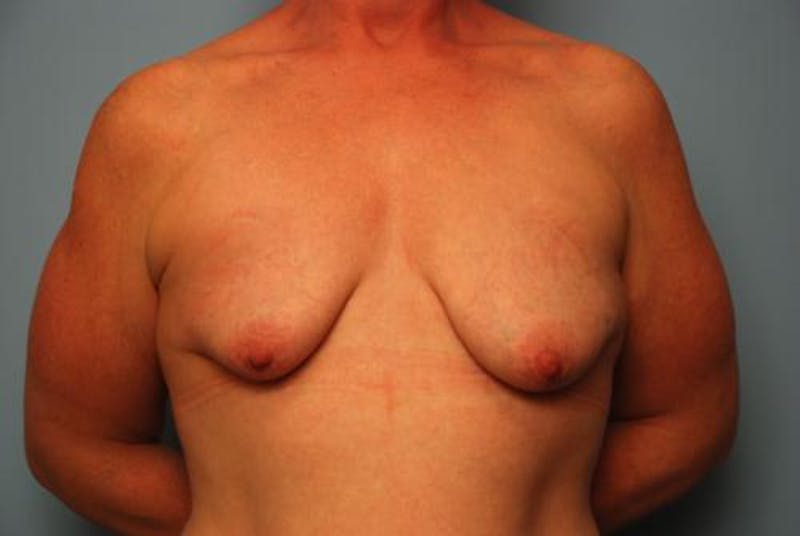 Breast Asymmetry Correction Before & After Gallery - Patient 626461 - Image 1
