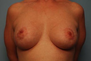 Breast Asymmetry Correction Before & After Gallery - Patient 626461 - Image 2