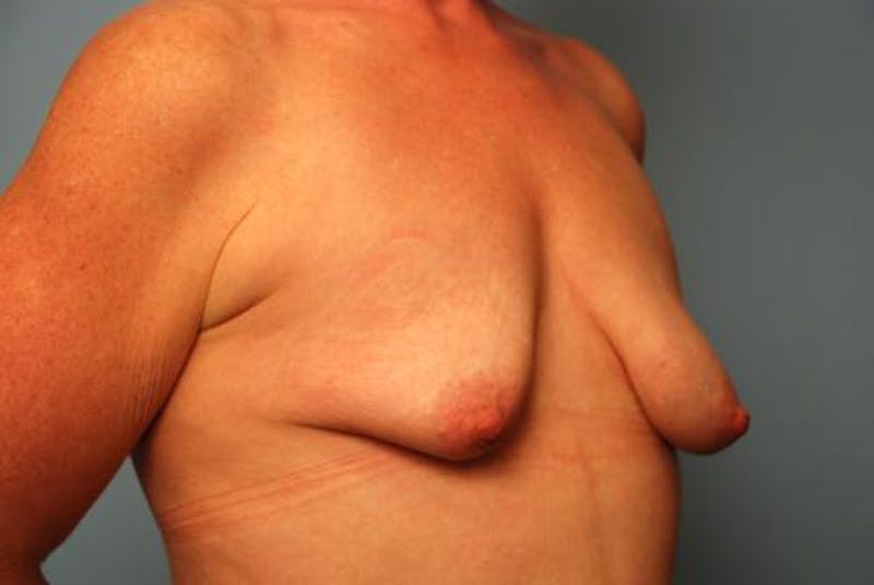 Breast Asymmetry Correction Before & After Gallery - Patient 626461 - Image 3