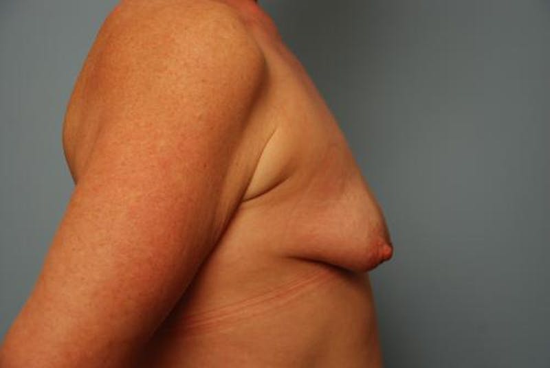 Breast Asymmetry Correction Before & After Gallery - Patient 626461 - Image 5