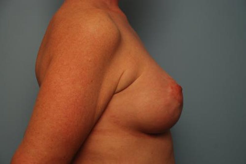 Breast Asymmetry Correction Before & After Gallery - Patient 626461 - Image 6