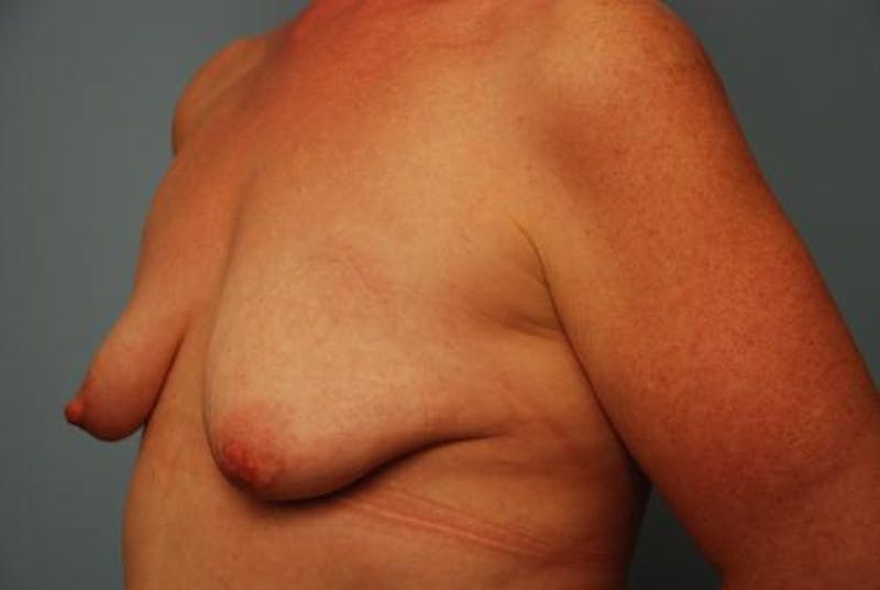 Breast Asymmetry Correction Before & After Gallery - Patient 626461 - Image 7