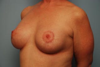 Breast Asymmetry Correction Before & After Gallery - Patient 626461 - Image 8