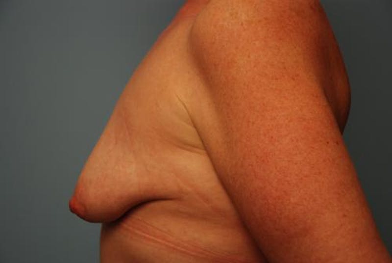 Breast Asymmetry Correction Before & After Gallery - Patient 626461 - Image 9