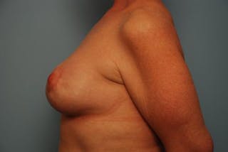Breast Asymmetry Correction Before & After Gallery - Patient 626461 - Image 10