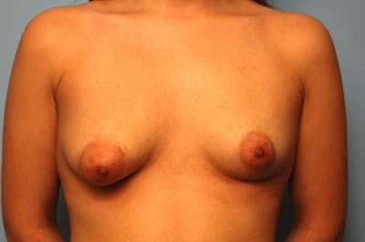 Breast Asymmetry Correction Before & After Gallery - Patient 103945 - Image 1