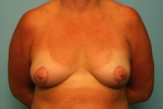 Breast Asymmetry Correction Before & After Gallery - Patient 203726 - Image 2