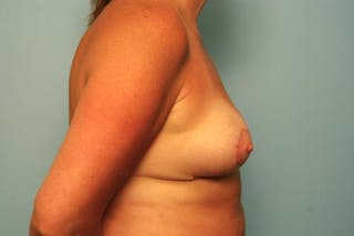 Breast Asymmetry Correction Before & After Gallery - Patient 203726 - Image 6