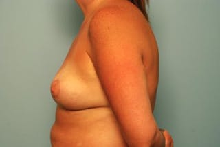 Breast Asymmetry Correction Before & After Gallery - Patient 203726 - Image 10