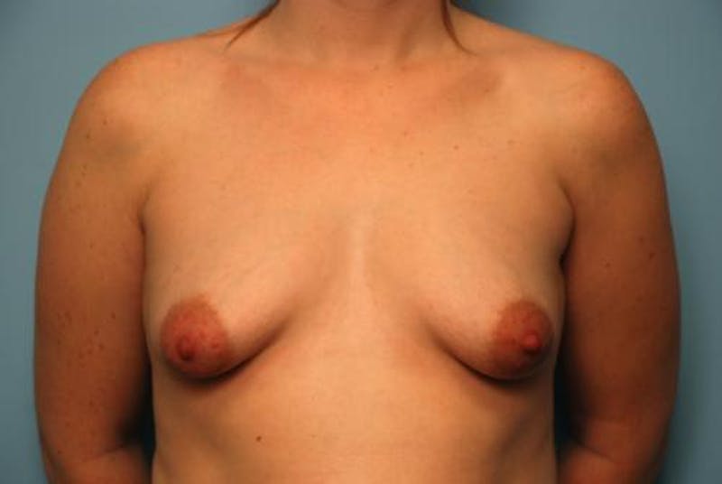 Breast Asymmetry Correction Before & After Gallery - Patient 170326 - Image 1