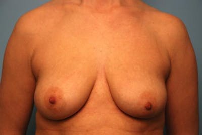 Breast Asymmetry Correction Before & After Gallery - Patient 399207 - Image 1