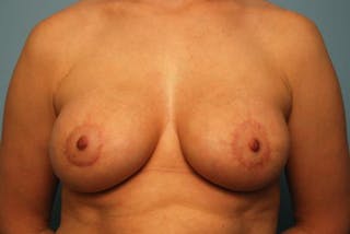 Breast Asymmetry Correction Before & After Gallery - Patient 354622 - Image 2