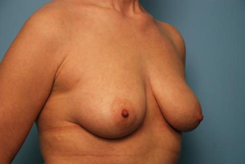 Breast Asymmetry Correction Before & After Gallery - Patient 354622 - Image 3