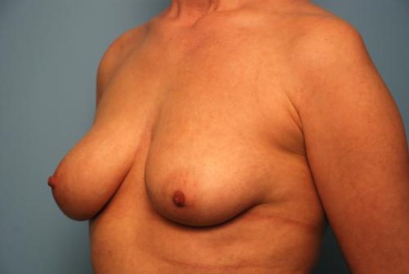 Breast Asymmetry Correction Before & After Gallery - Patient 354622 - Image 7