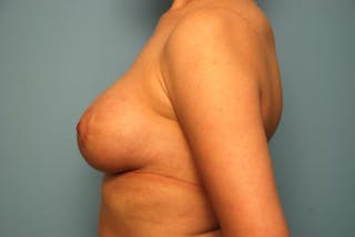 Breast Asymmetry Correction Before & After Gallery - Patient 354622 - Image 10