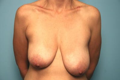 Breast Asymmetry Correction Before & After Gallery - Patient 339197 - Image 1
