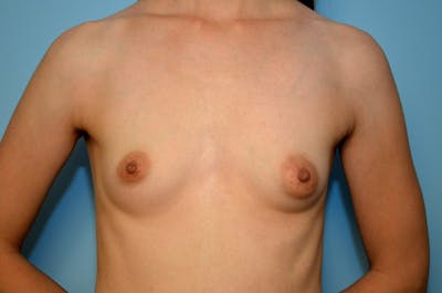 Breast Asymmetry Correction Before & After Gallery - Patient 332411 - Image 1