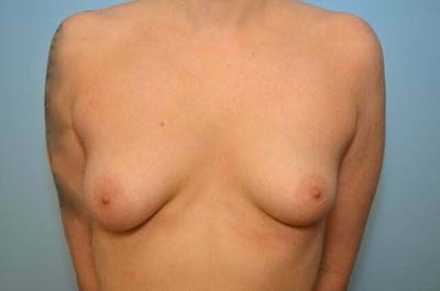 Breast Asymmetry Correction Before & After Gallery - Patient 339427 - Image 1