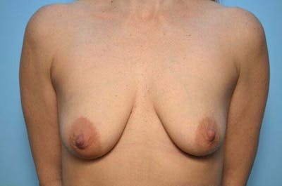 Breast Asymmetry Correction Before & After Gallery - Patient 163383 - Image 1
