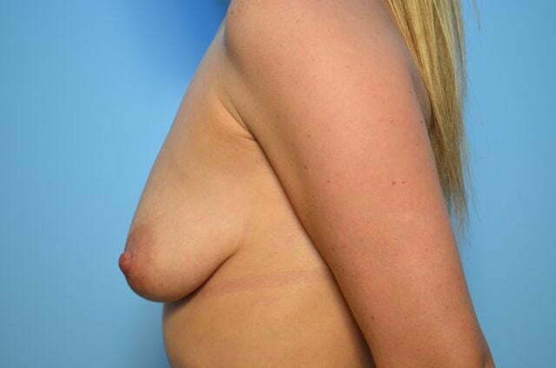 Breast Asymmetry Correction Before & After Gallery - Patient 219451 - Image 9