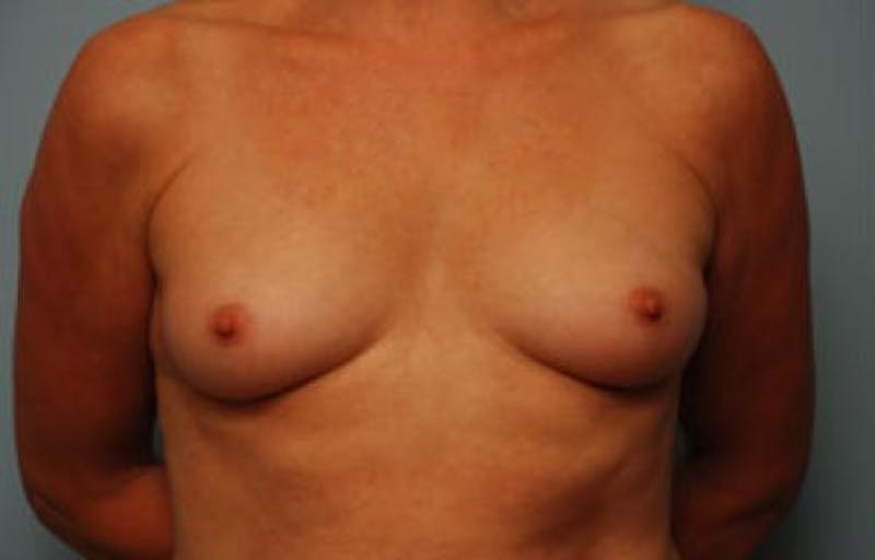 Breast Augmentation Before & After Gallery - Patient 189938 - Image 1