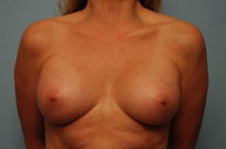 Breast Augmentation Before & After Gallery - Patient 189938 - Image 2