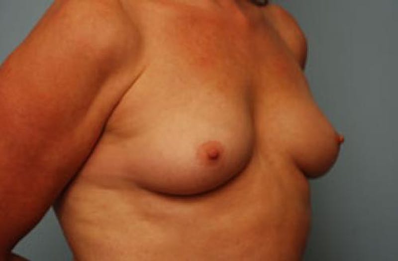 Breast Augmentation Before & After Gallery - Patient 189938 - Image 3
