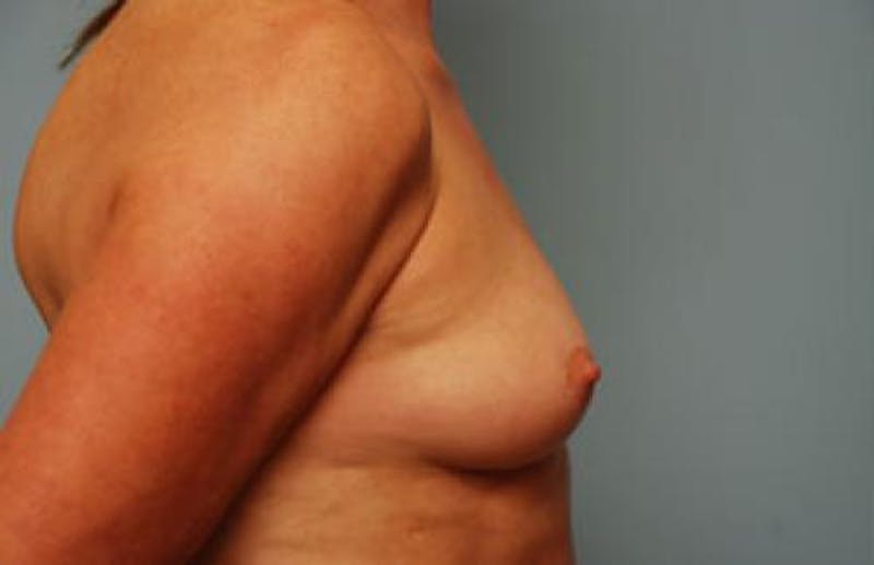 Breast Augmentation Before & After Gallery - Patient 189938 - Image 5