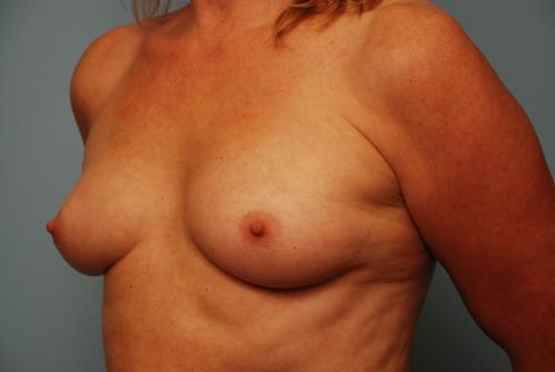 Breast Augmentation Before & After Gallery - Patient 189938 - Image 7