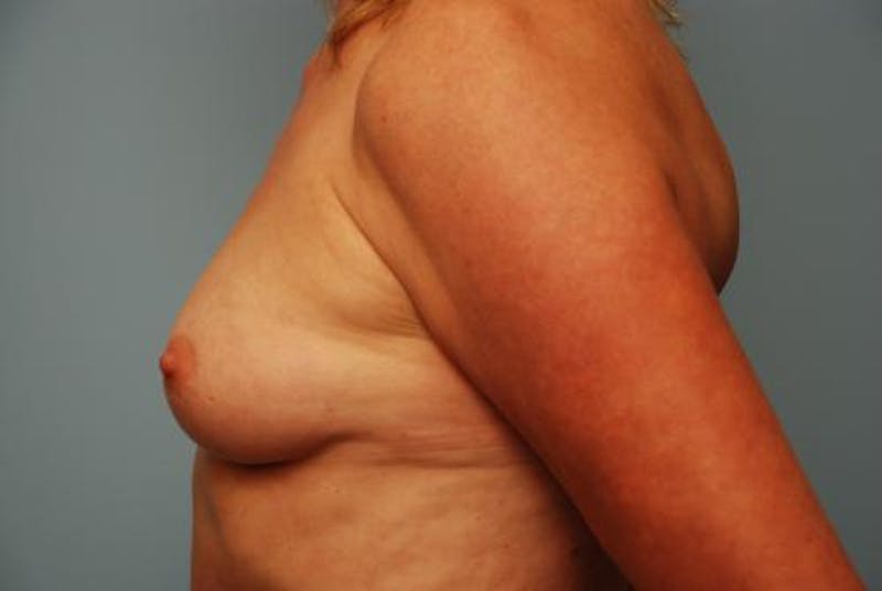Breast Augmentation Before & After Gallery - Patient 189938 - Image 9