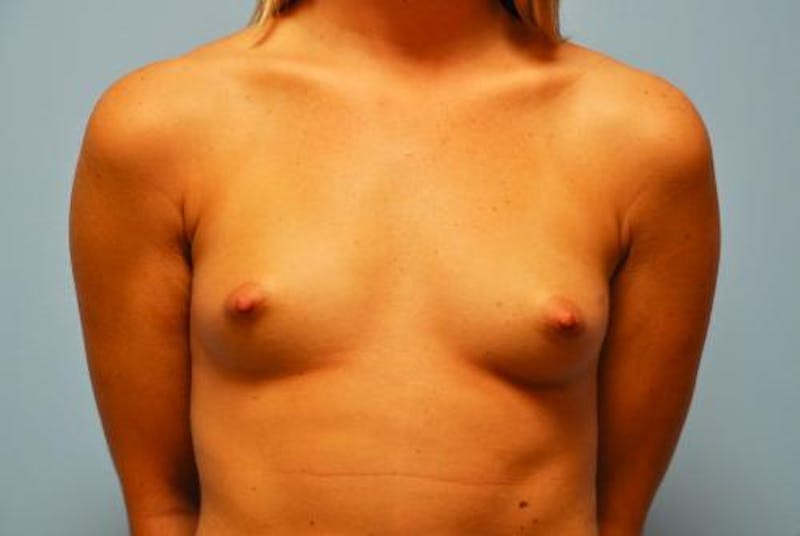 Breast Augmentation Before & After Gallery - Patient 338061 - Image 1
