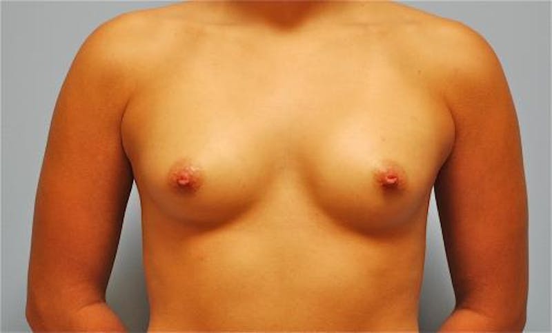 Breast Augmentation Before & After Gallery - Patient 407660 - Image 1
