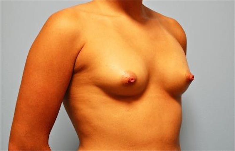 Breast Augmentation Before & After Gallery - Patient 407660 - Image 3