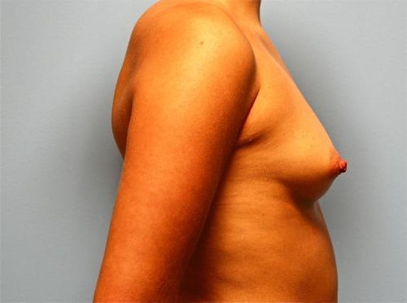Breast Augmentation Before & After Gallery - Patient 407660 - Image 5