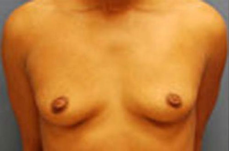 Breast Augmentation Before & After Gallery - Patient 348897 - Image 1