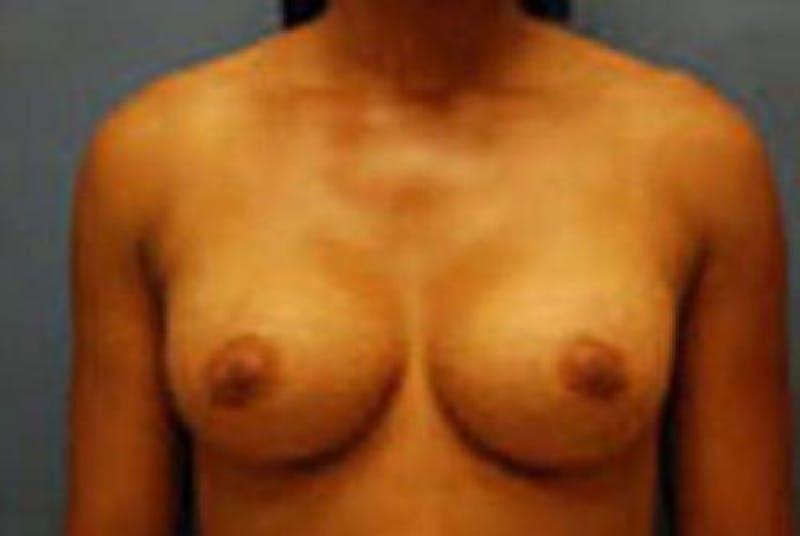 Breast Augmentation Before & After Gallery - Patient 348897 - Image 2