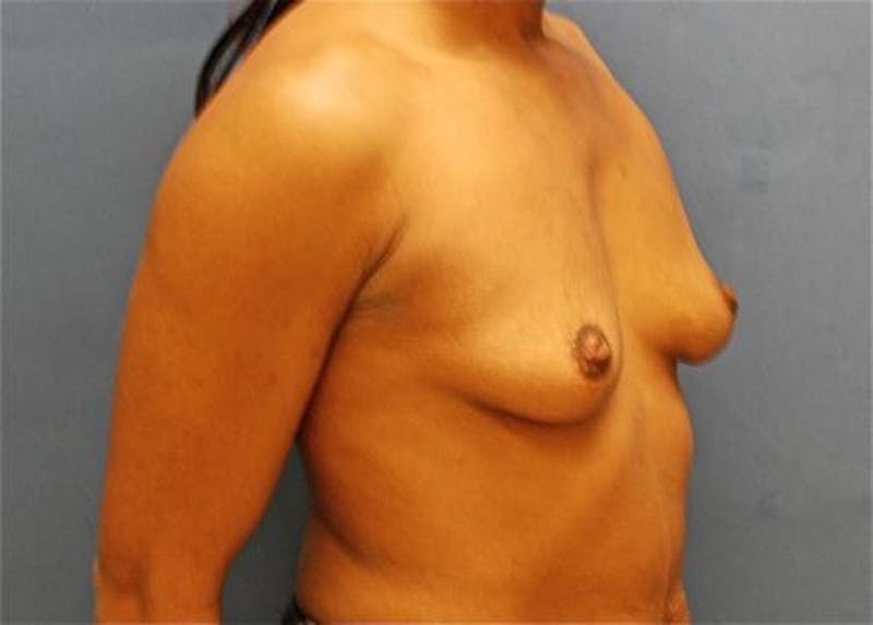 Breast Augmentation Before & After Gallery - Patient 348897 - Image 3