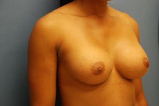 Breast Augmentation Before & After Gallery - Patient 348897 - Image 4