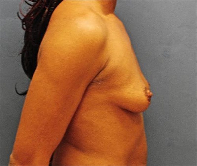 Breast Augmentation Before & After Gallery - Patient 348897 - Image 5