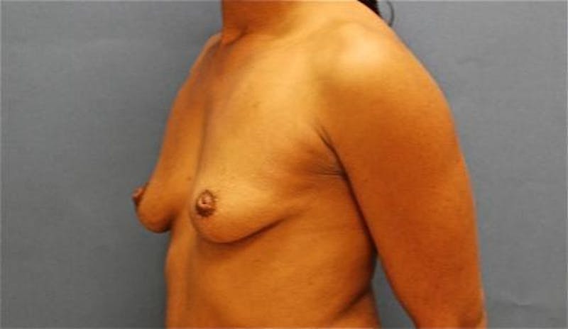 Breast Augmentation Before & After Gallery - Patient 348897 - Image 7