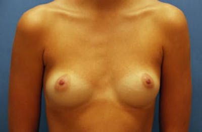 Breast Augmentation Before & After Gallery - Patient 194032 - Image 1