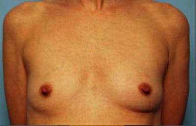 Breast Augmentation Before & After Gallery - Patient 379535 - Image 1