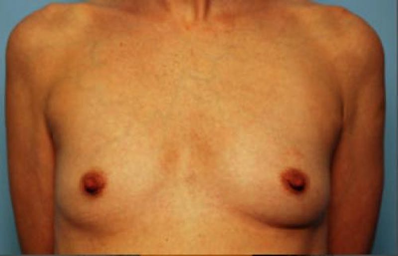 Breast Augmentation Before & After Gallery - Patient 327819 - Image 1